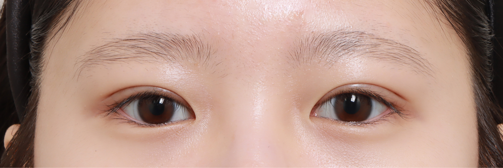 눈성형 After 정면