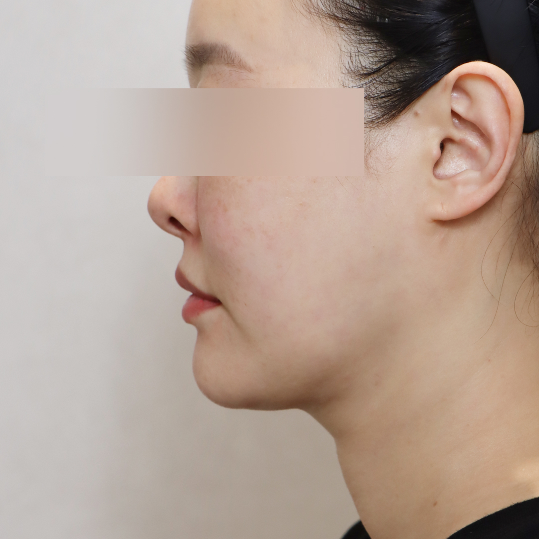 안면거상술 before 90도 이미지