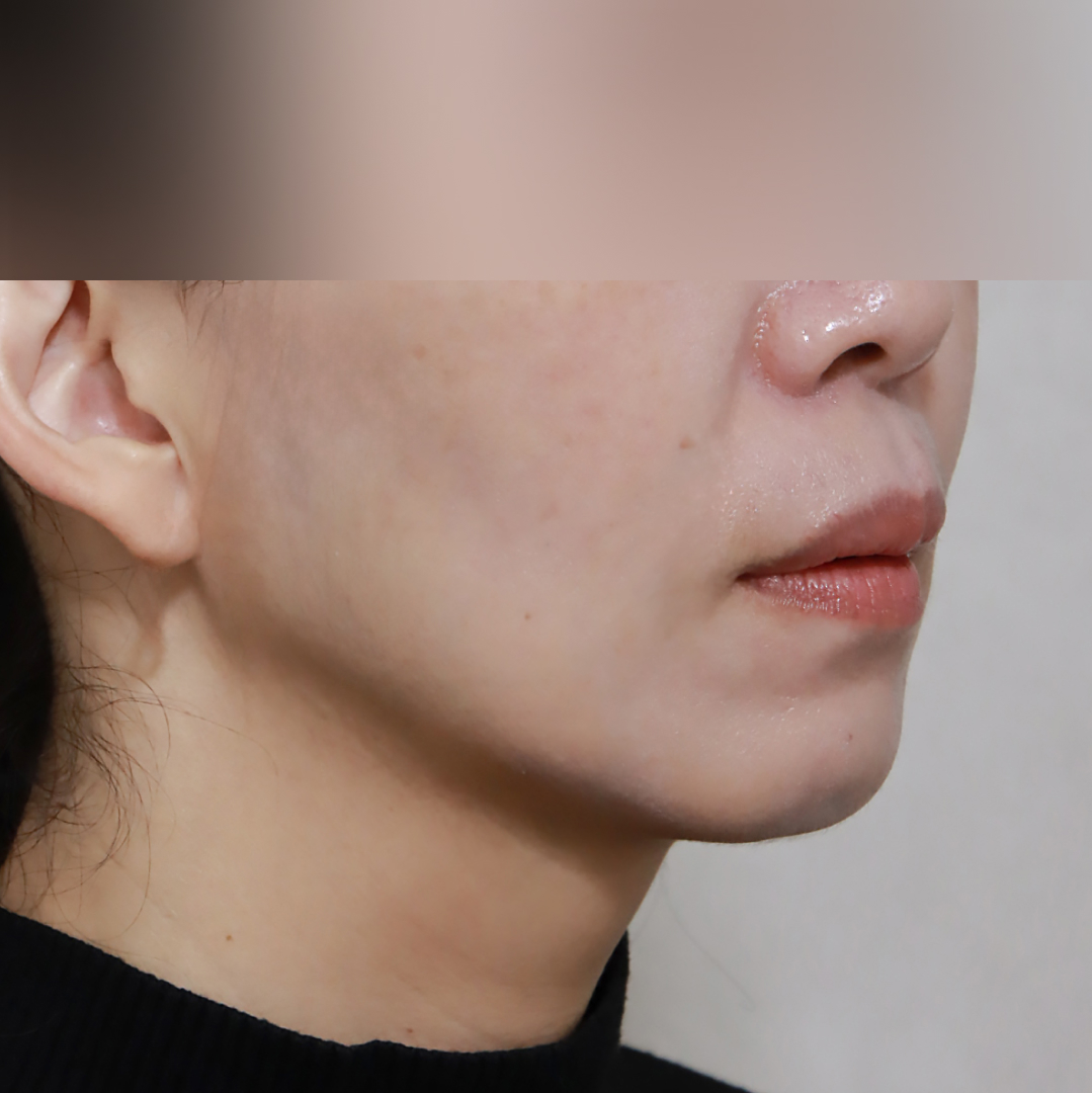 실리프팅 after측면 이미지