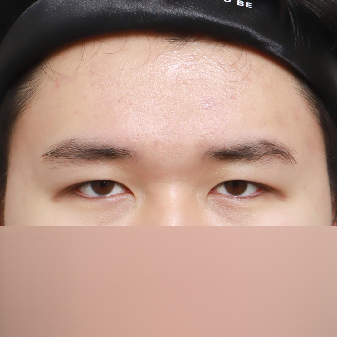 눈성형 After 정면