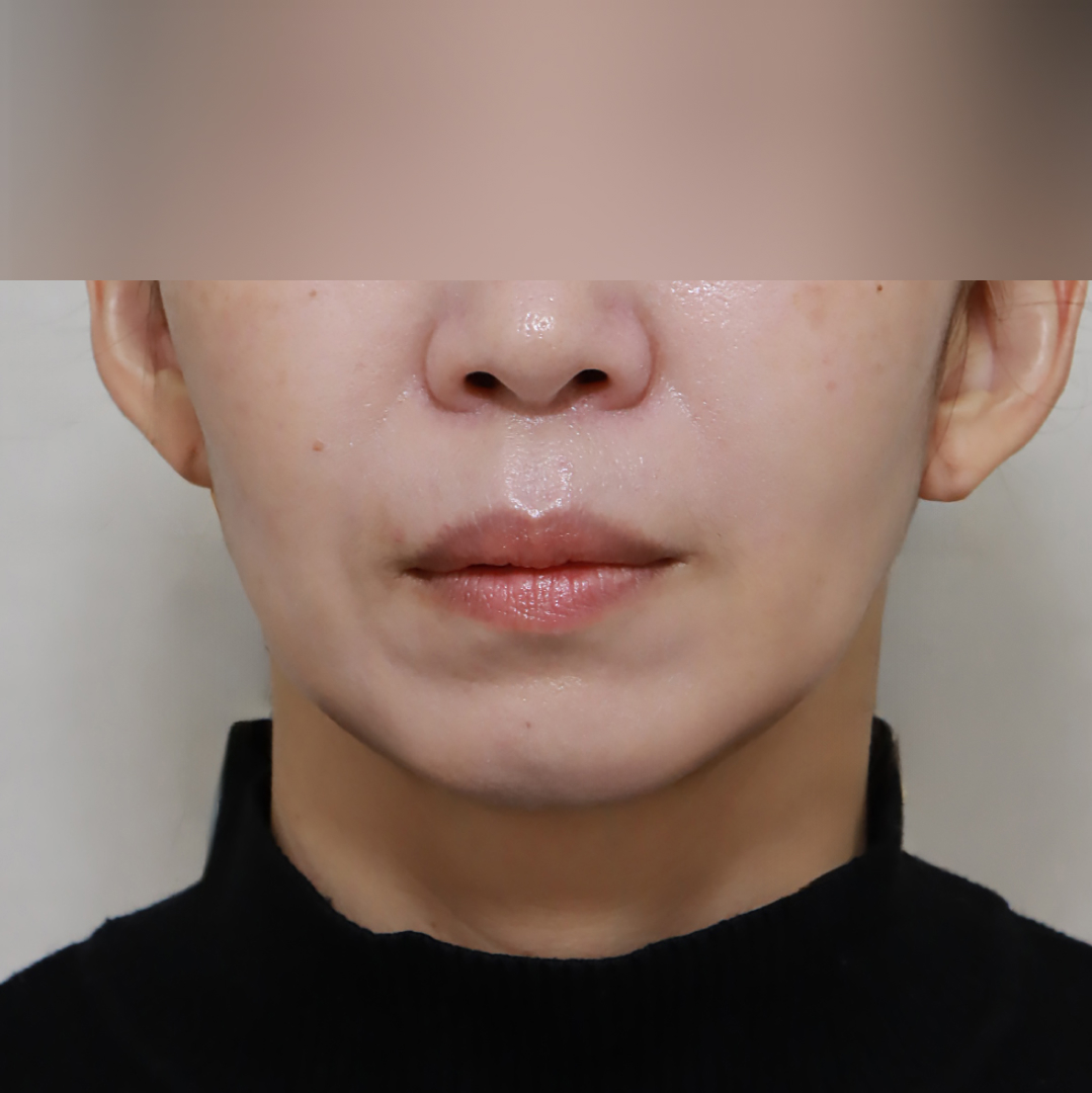 실리프팅 after정면 이미지