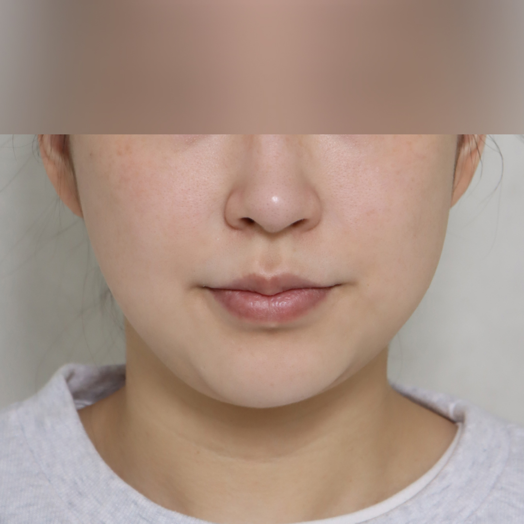 실리프팅 before정면 이미지