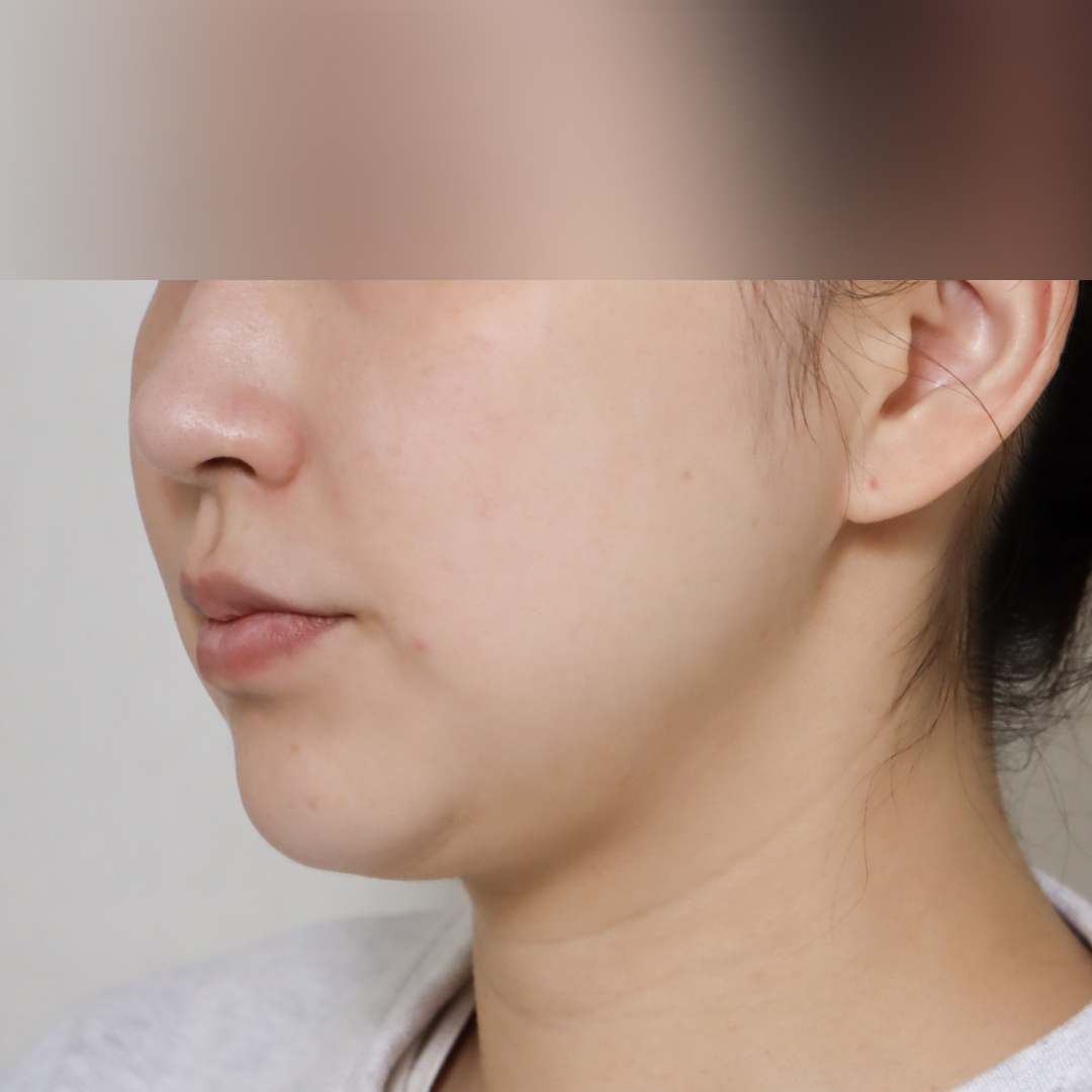 실리프팅 before측면 이미지