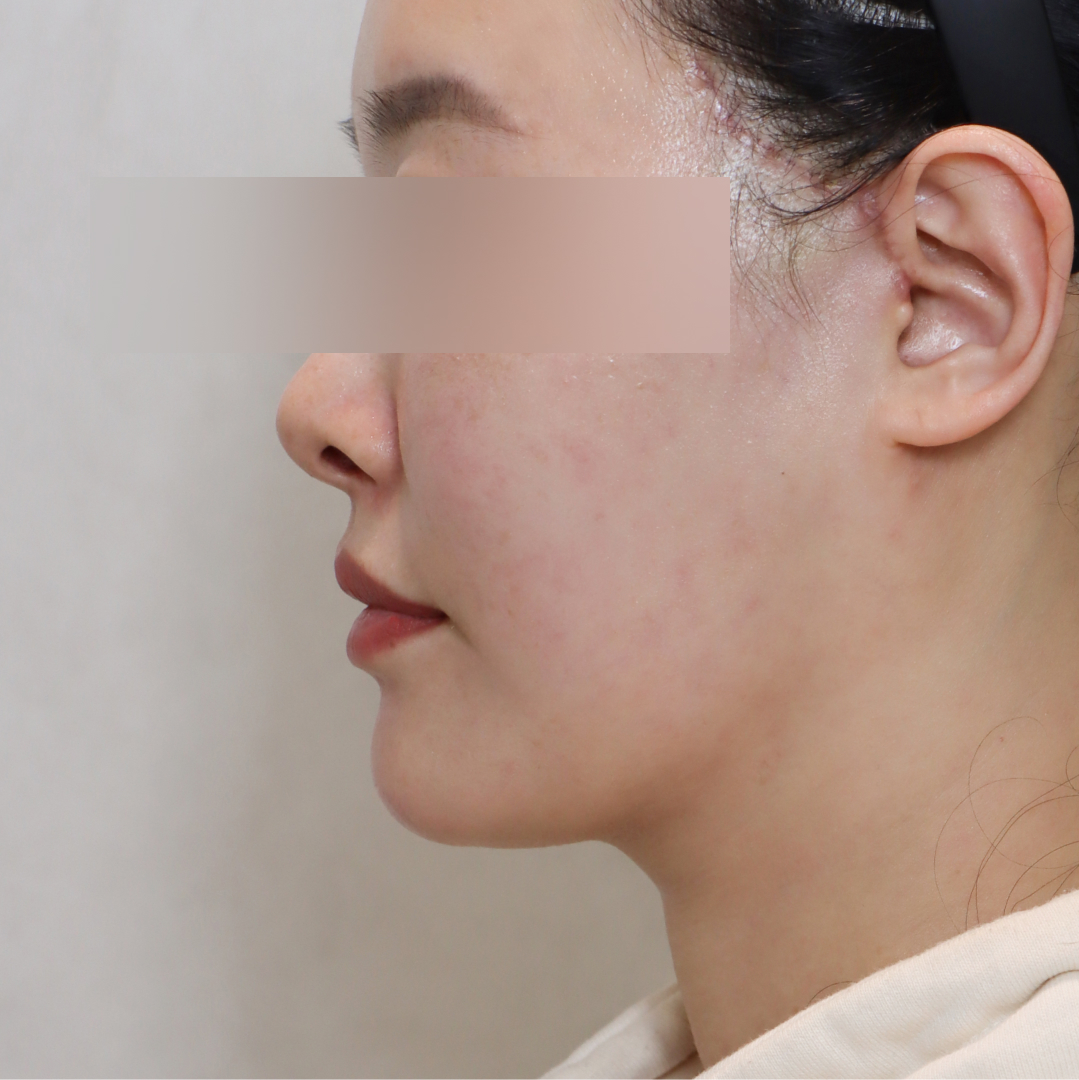 안면거상술 after 90도 이미지