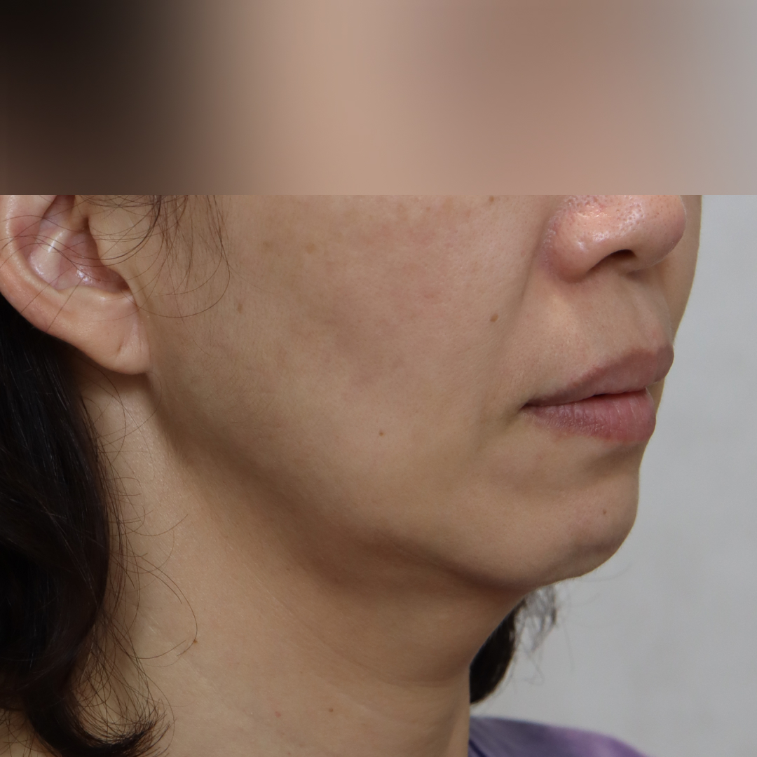 실리프팅 before측면 이미지