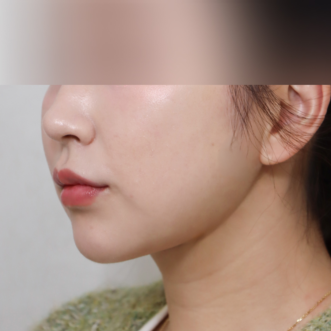 실리프팅 after측면 이미지