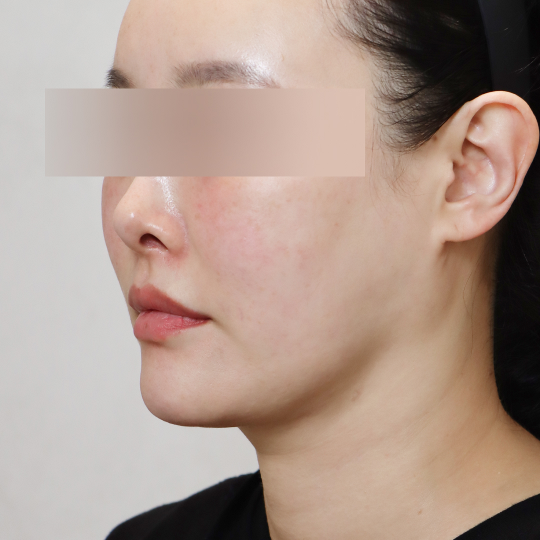 안면거상술 before측면 이미지