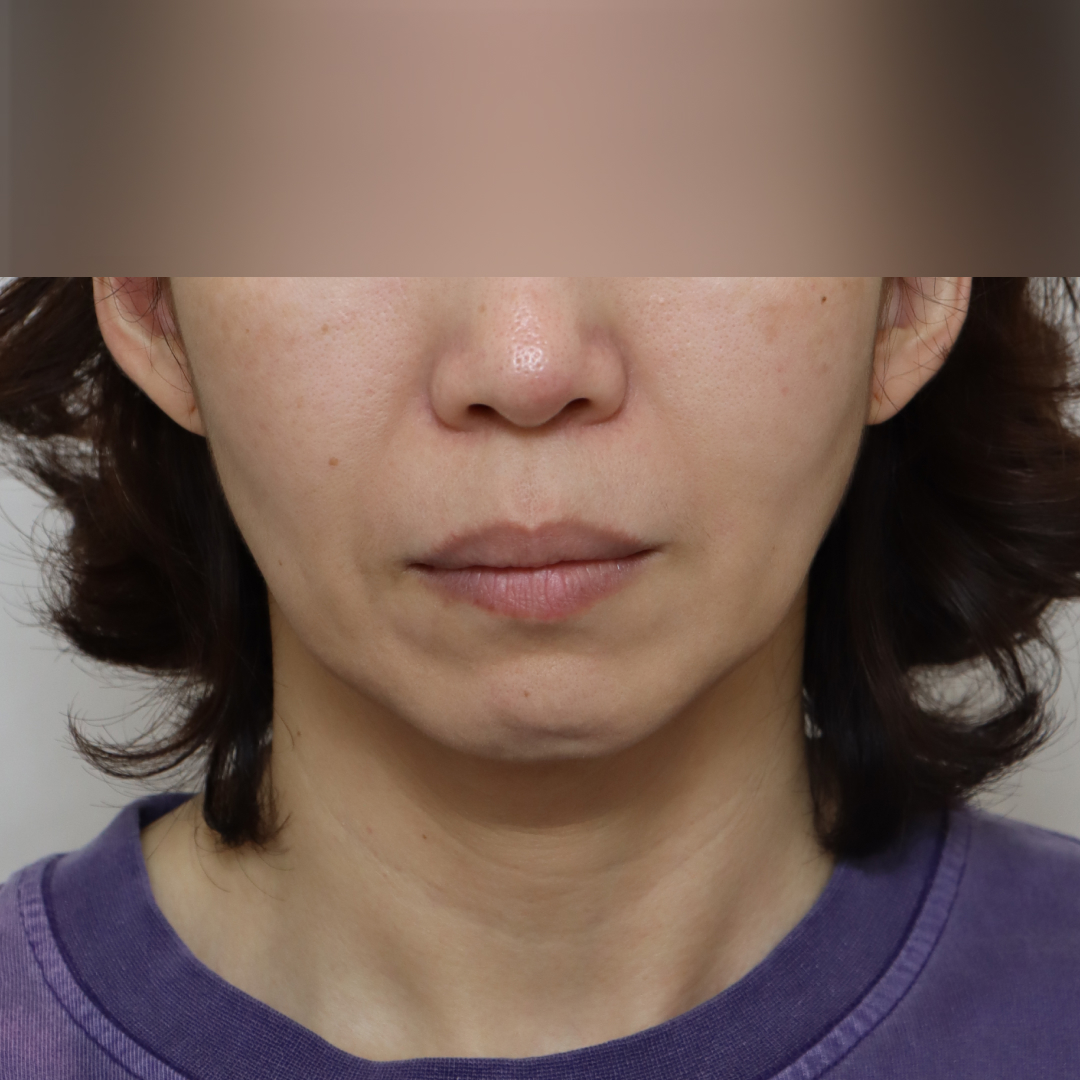 실리프팅 before정면 이미지