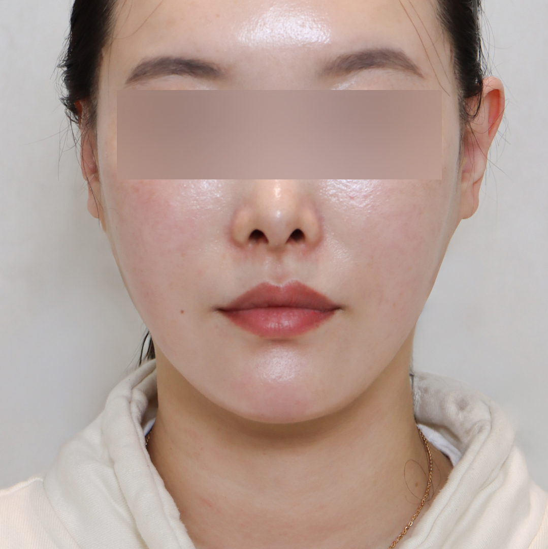 안면거상술 after정면 이미지