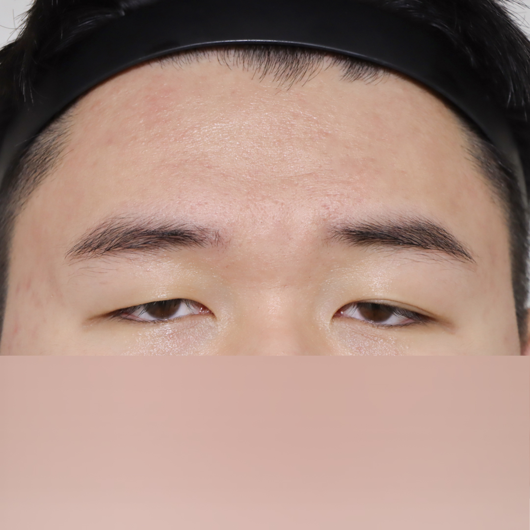 눈성형 Before 정면
