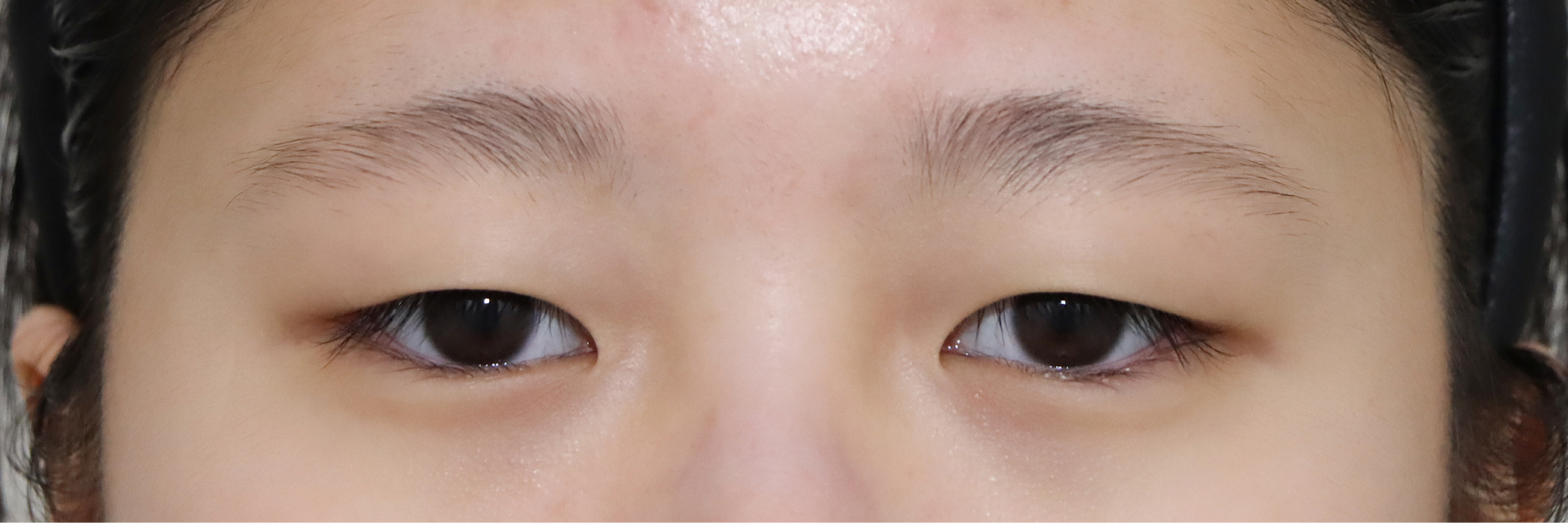 눈성형 Before 정면