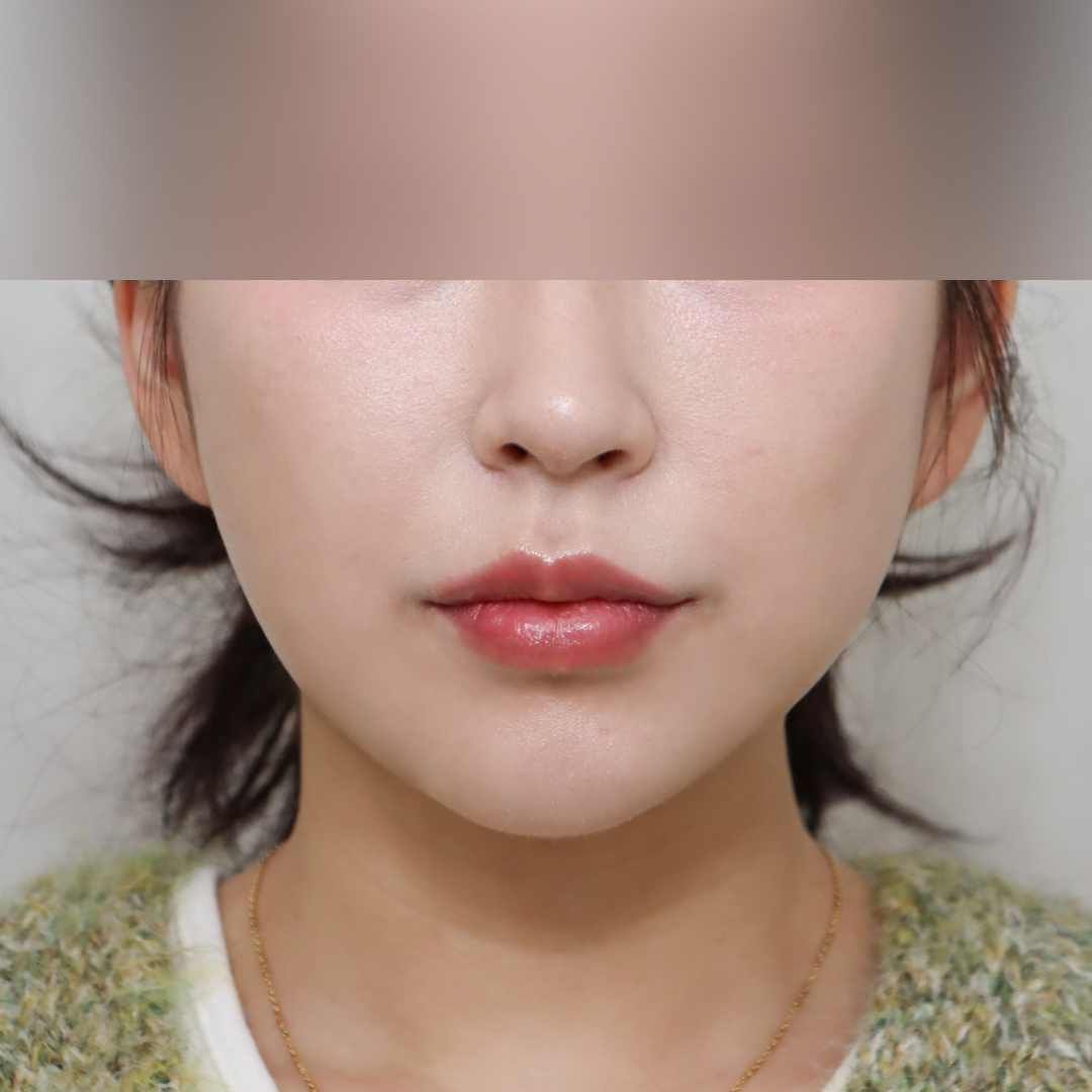 실리프팅 after정면 이미지