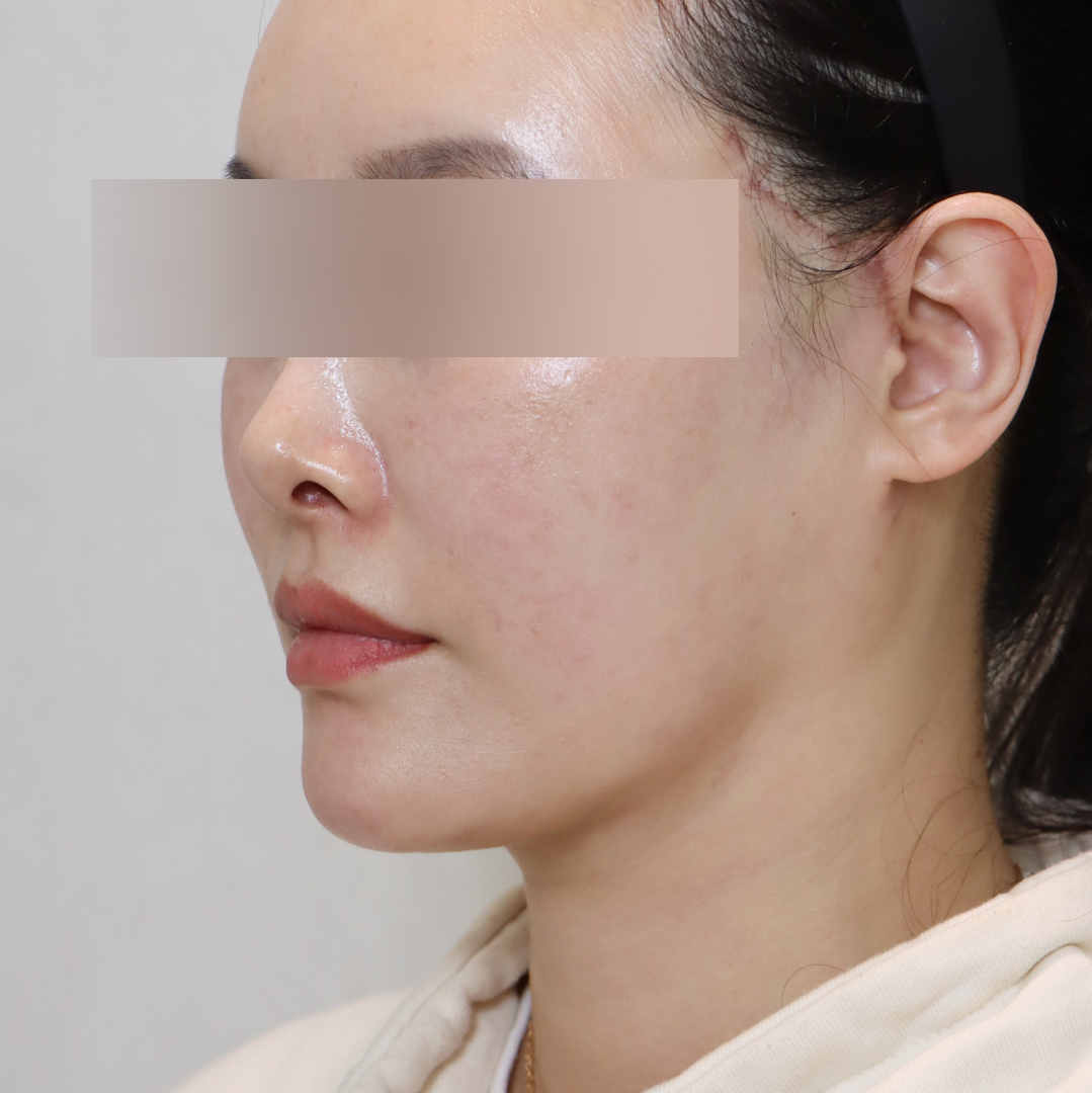 안면거상술 after측면 이미지