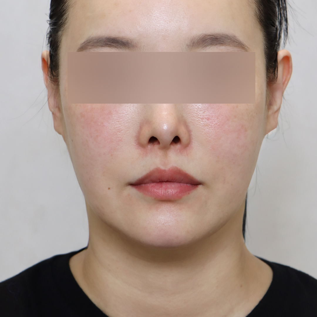 안면거상술 before측면 이미지