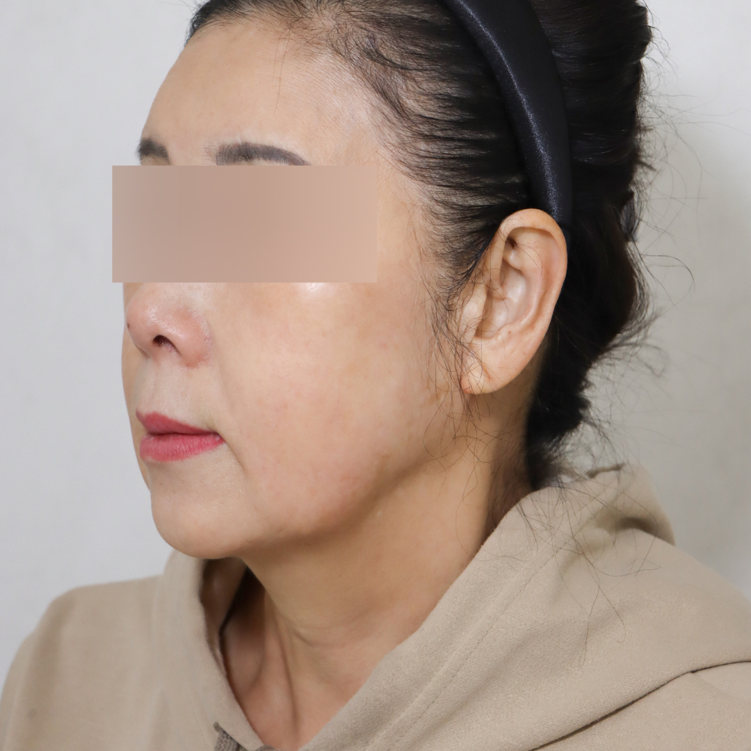 안면거상술 before측면 이미지