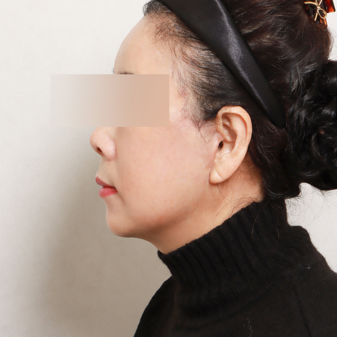 안면거상술 after 90도 이미지