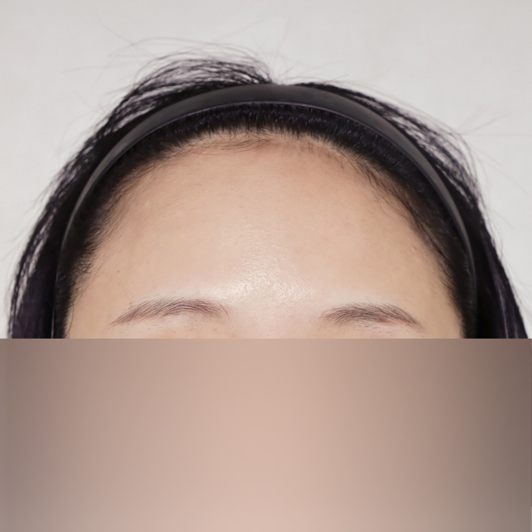 이마축소술 before측면 이미지