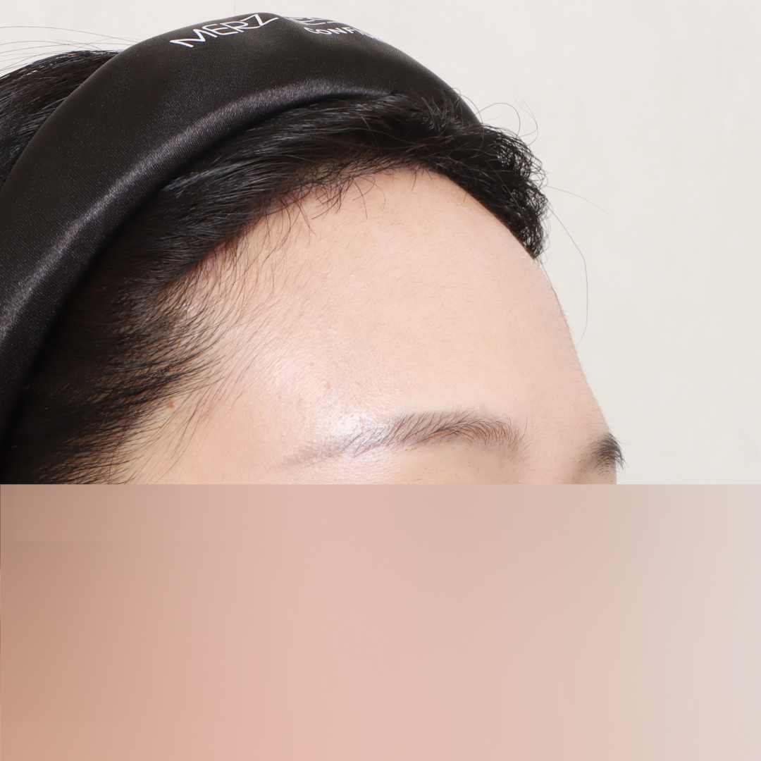 이마축소술 after정면 이미지
