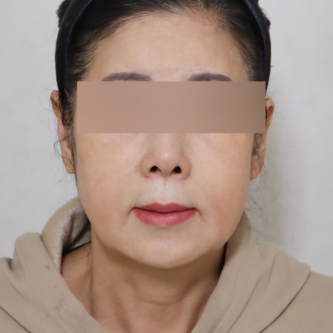 안면거상술 before정면 이미지