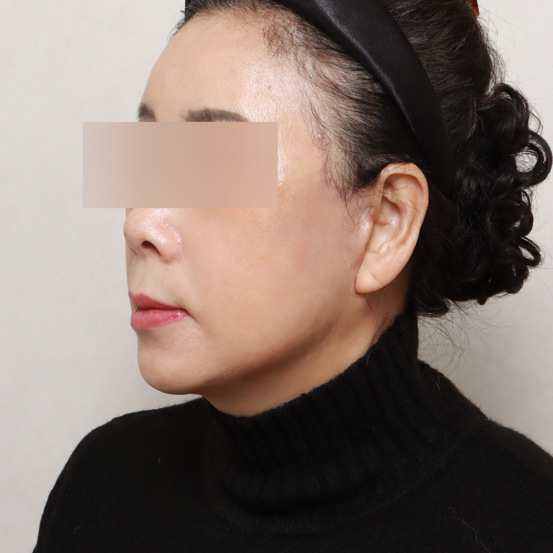 안면거상술 after측면 이미지