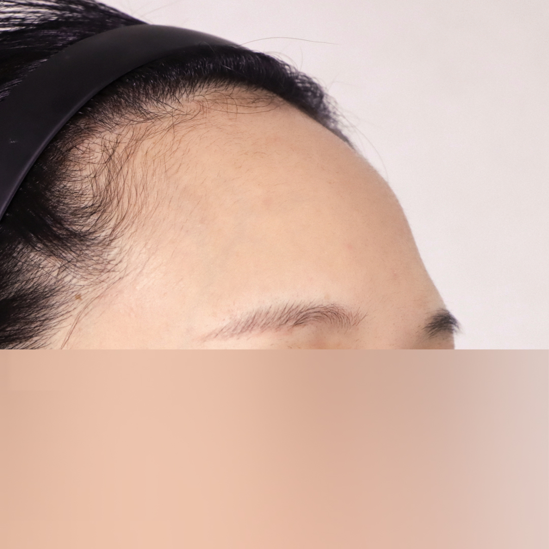 이마축소술 before측면 이미지