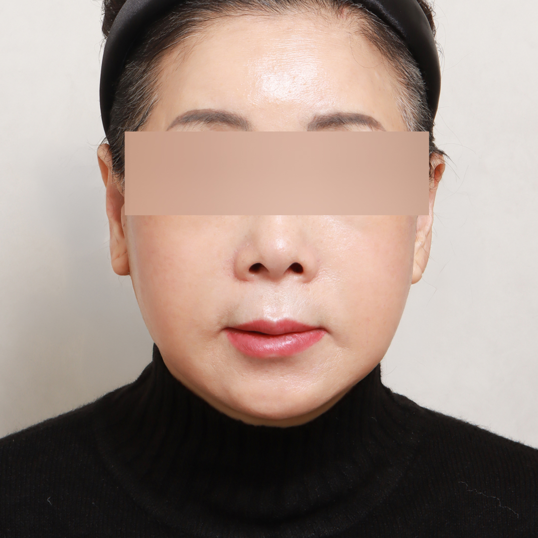 안면거상술 after정면 이미지