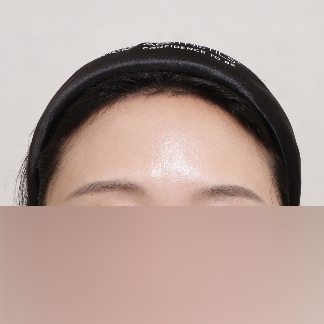 이마축소술 after정면 이미지