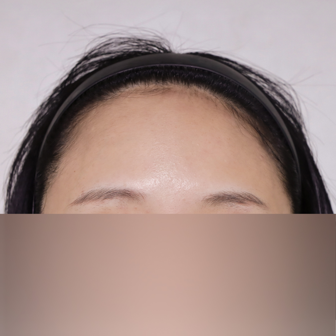 이마축소술 after측면 이미지