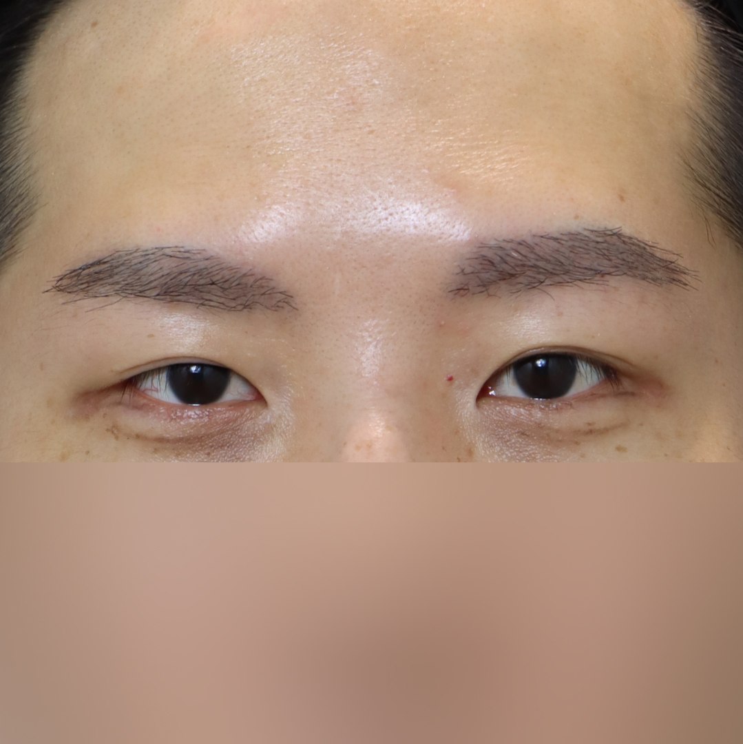 실리프팅 After 정면