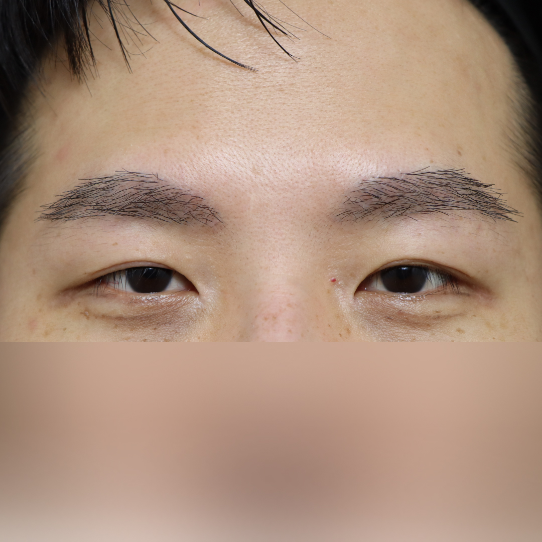 실리프팅 Before 정면