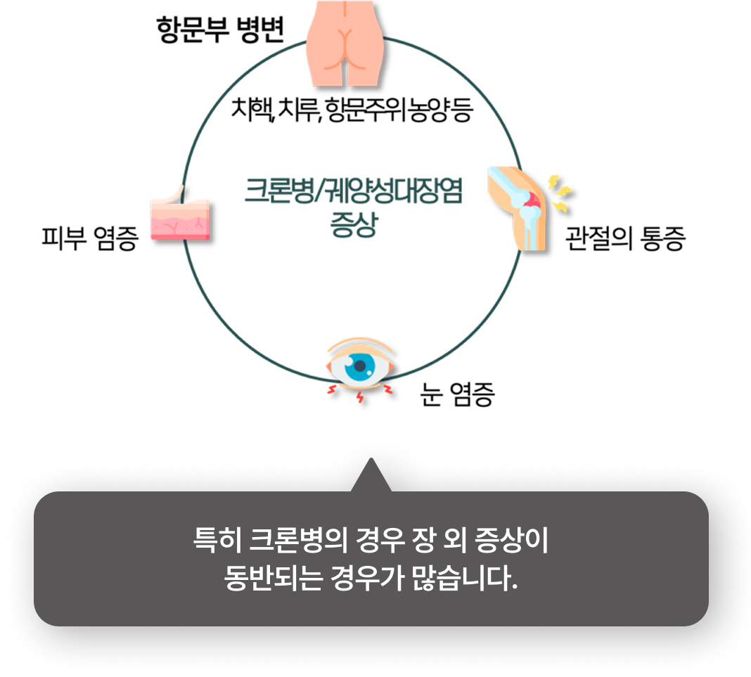 이비엠 쇼그렌 증후군