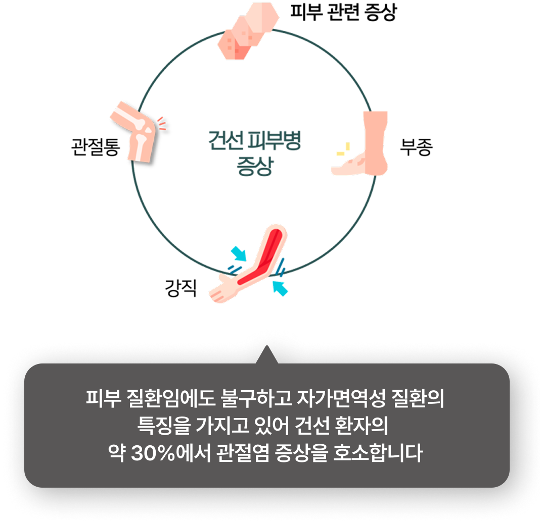 이비엠 쇼그렌 증후군