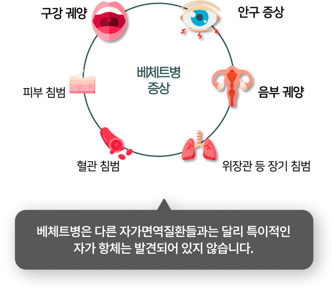 이비엠 쇼그렌 증후군