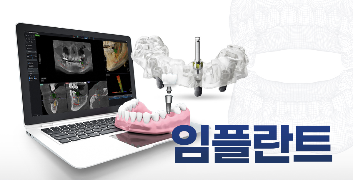임플란트
