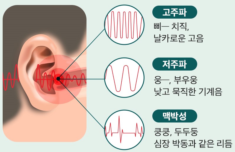 이명 증상
