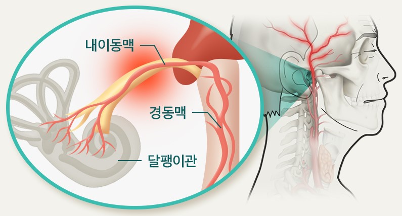 이명이란