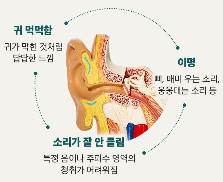 난청 증상