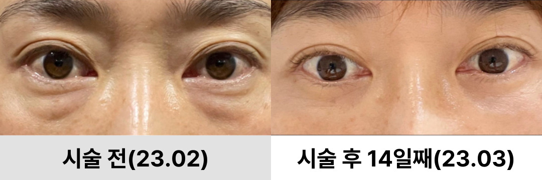 눈밑지방제거 시술 전