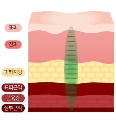 극초단파 UHF 피팅 리프팅
