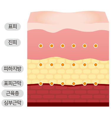 HIFU 고강도 집속 초음파