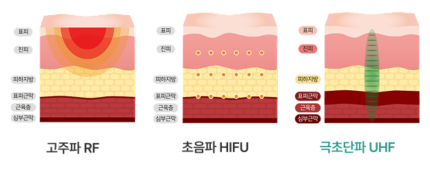 RF vs HIFU vs UHF 피팅 리프팅 비교