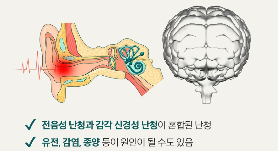 혼합성난청