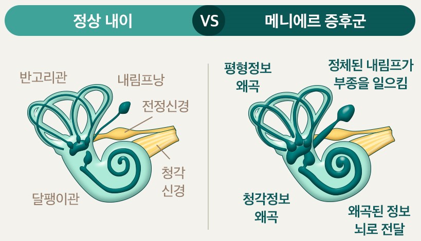 메니에르병