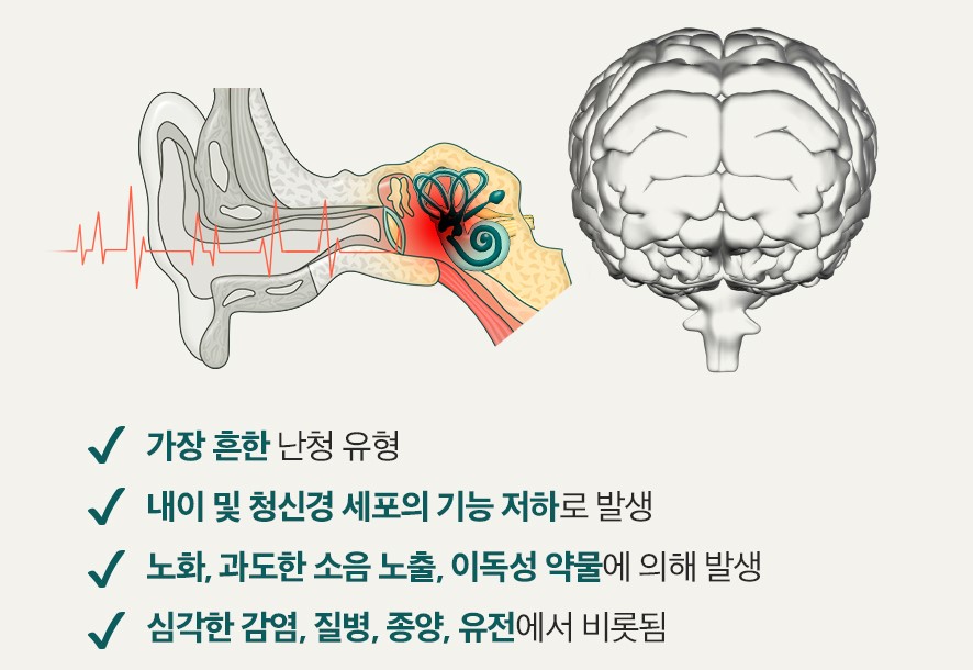 감각신경성난청