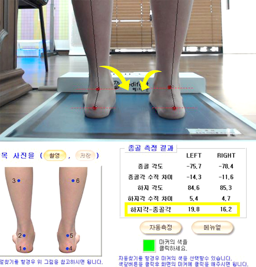  발목 각도와 발바닥 압력을 정밀하게 검사합니다. 정상 발목 각도는 0~9도로 측정되며 정렬에서 벗어날수록 20도에 가깝게 측정됩니다