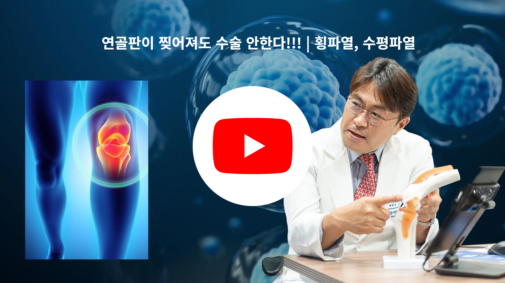 무릎 연골판 파열, 꼭 수술해야 할까요? 유투브 채널 확인!