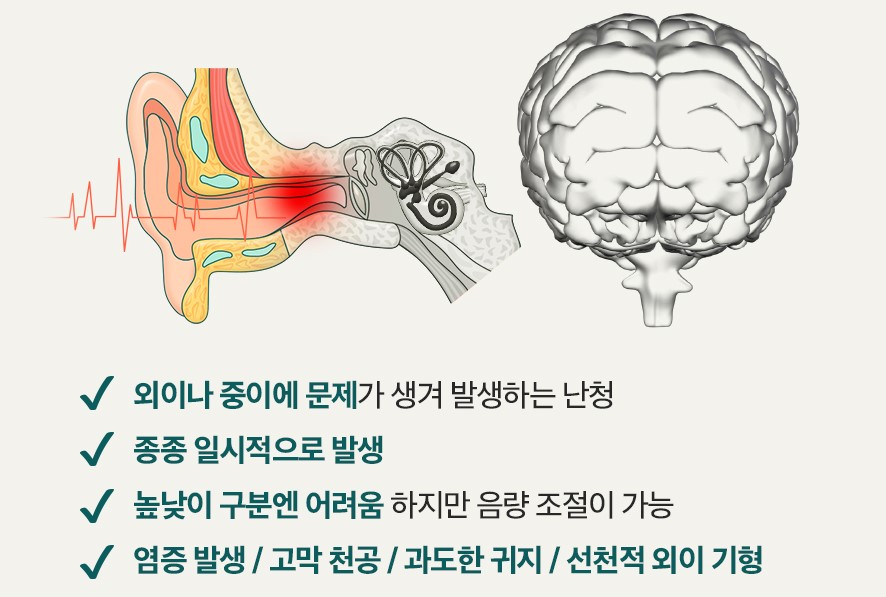 전음성난청