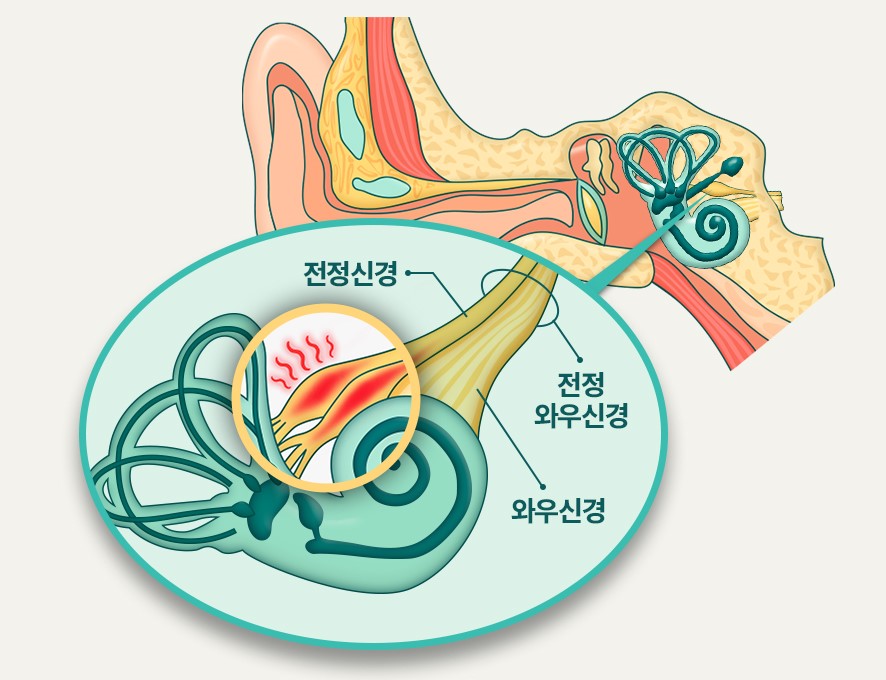 전정신경염