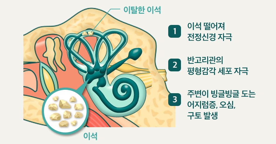 이석증