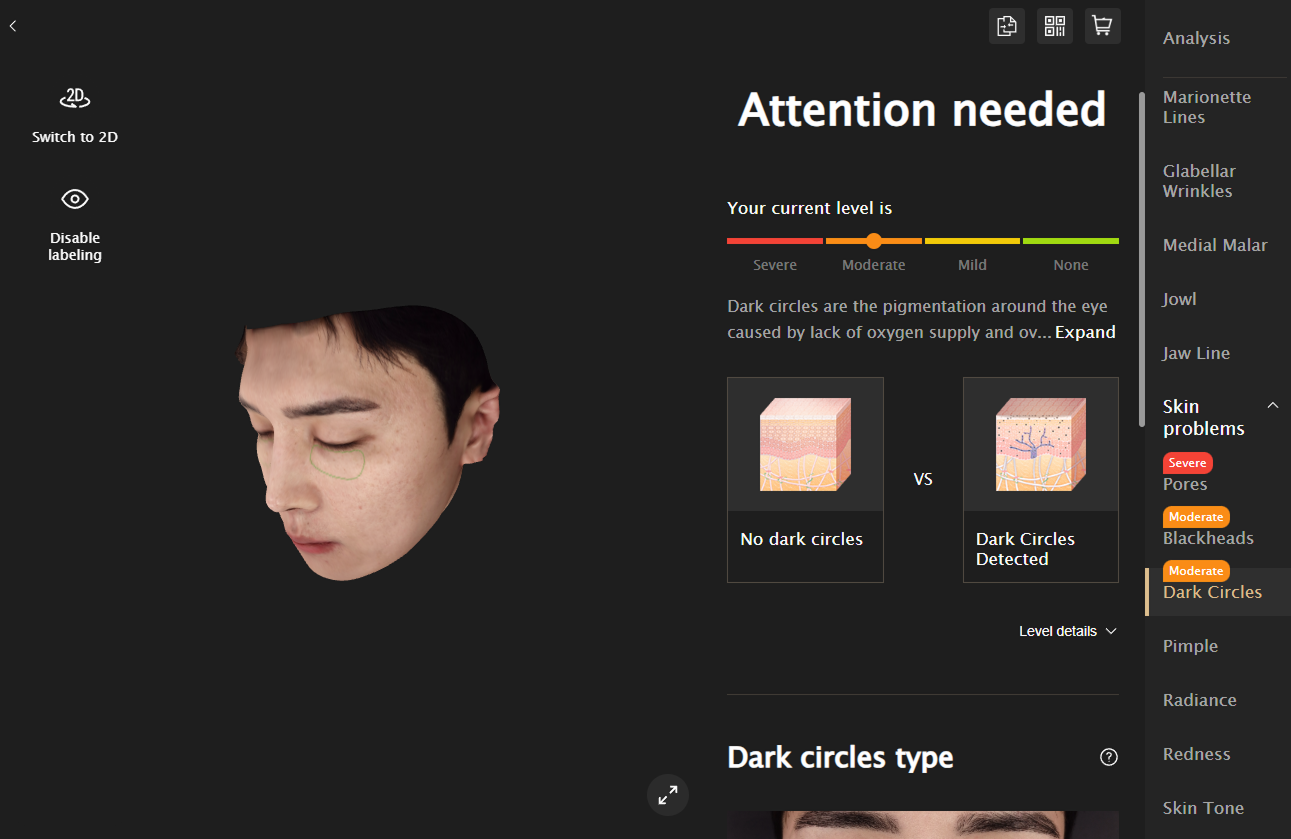 다크서클 타입 및 깊이 분석